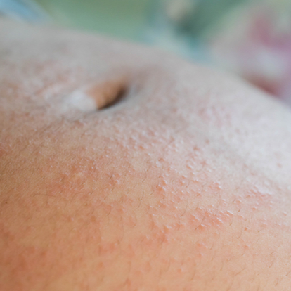 Pregnancy - Related Skin Conditions